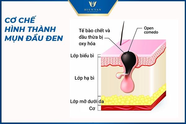 Mụn đầu đen là gì? Nguyên nhân gây mụn đầu đen và giải pháp trị mụn an toàn