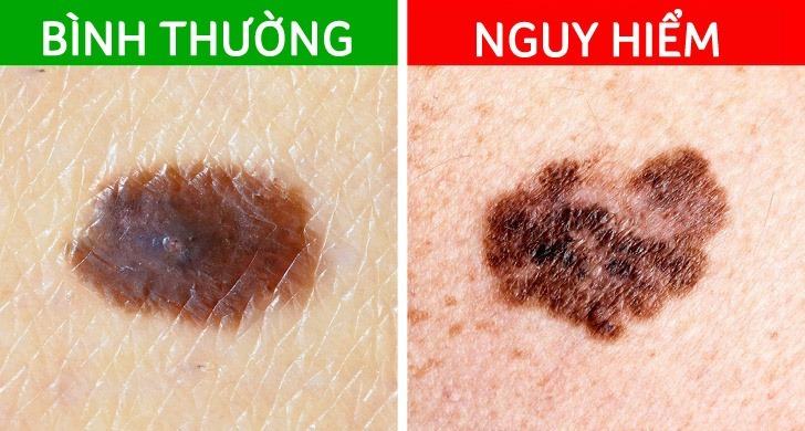 Cách tẩy nốt ruồi