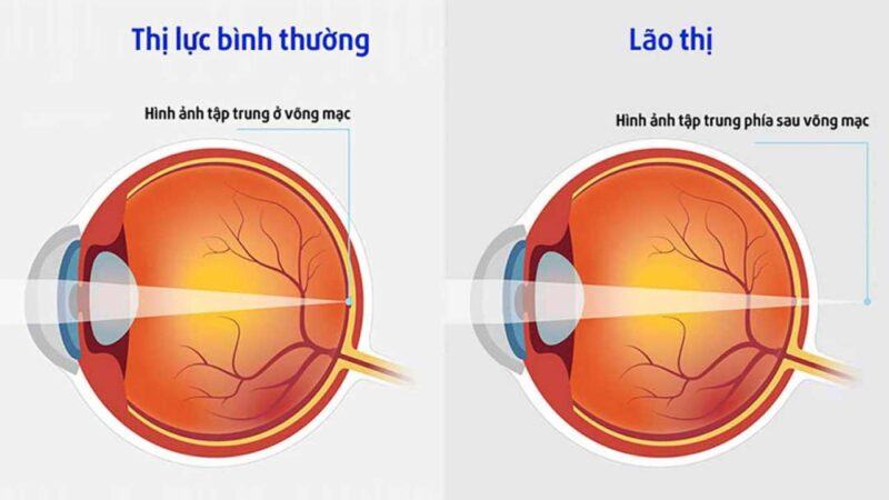 Tại sao người già phải đeo kính lão? Tác dụng của kính lão