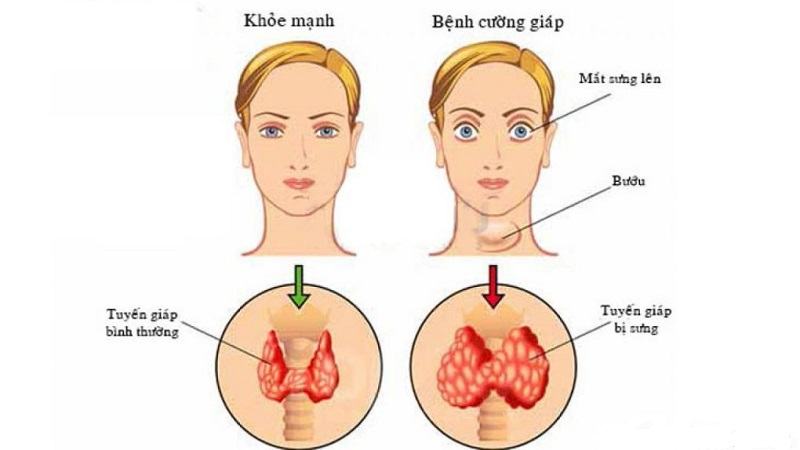 tuyến giáp nằm ở đâu